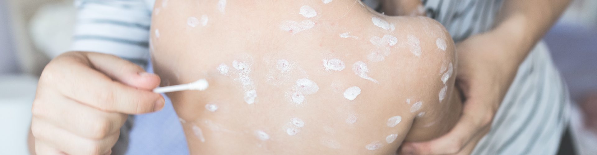 chicken pox spots