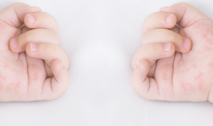 don't ignore your allergy symptoms - baby with rash on arm