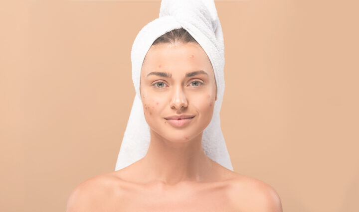 woman with acne wondering How to Safely Treat Your Postpartum Acne