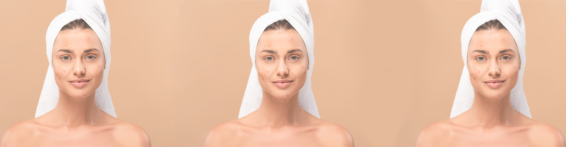 woman with acne wondering How to Safely Treat Your Postpartum Acne